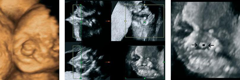 Three-dimensional ultrasound diagnosis of cleft palate 403 Figure 4 (a) Surface-rendered image of the fetal face at 23 weeks gestation, with bilateral cleft lip and palate involving the lip, maxilla