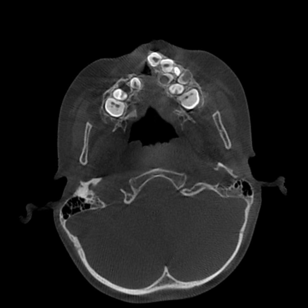 Fig. 4: Congenital absence of the cleft-side lateral