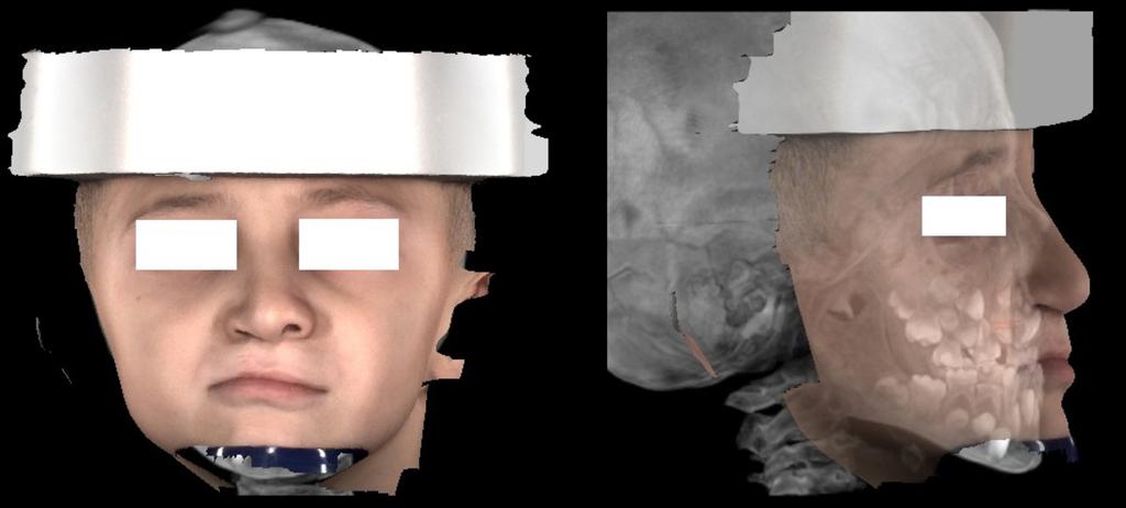 Fig. 6: Proface image of a CLP patient. Fig.