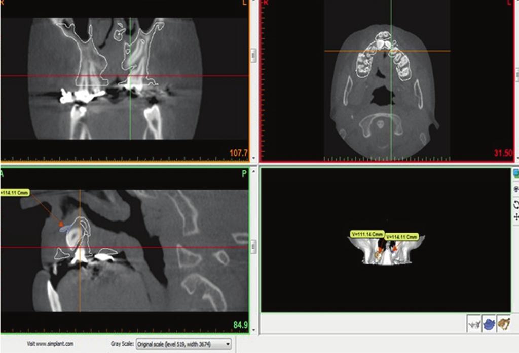 The appraisal of ACG was further augmented by volumetric calculations achieved through CBCT images.