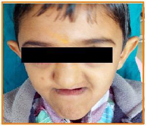 Introduction Clefts involving lips and palate are the most commonly seen congenital anomalies involving the maxillofacial region [1].