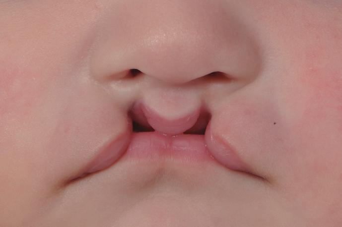 The nasal width to facial width ratio (Al-Al/Zy-Zy), the nasal width to intercanthal distance ratio (Al-Al/En-En), and the columellar width to nasal width ratio (Sn -Sn /Al-Al) for the 2 groups were