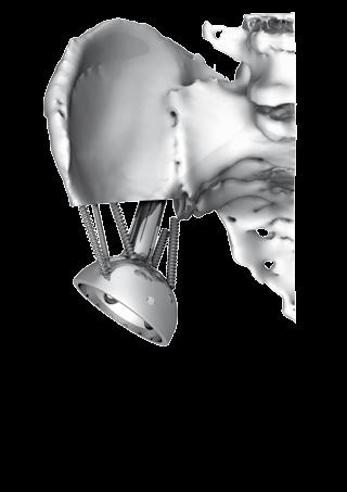 Once the Ilium has been correctly B prepared, using the long impactor and hammer, insert the coned hemi-pelvis implant in the correct orientation. C Using bone cement, reconstruct the pelvis.