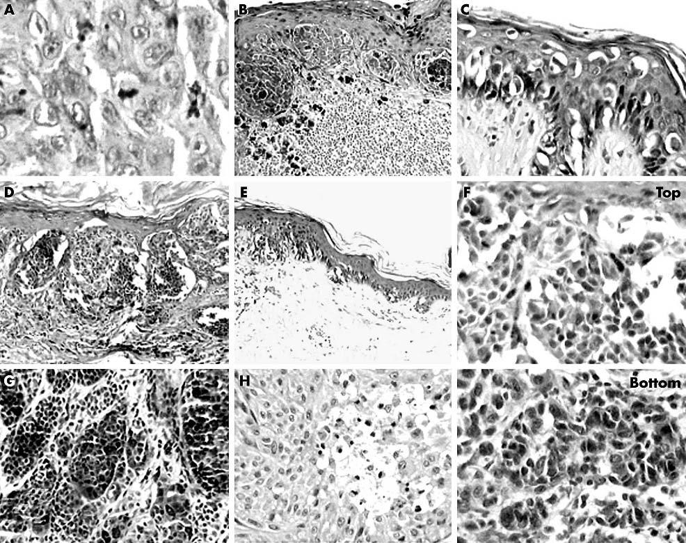 Interobserver reproducibility of histological melanoma features 1195 Figure 1 (A) Melanocytic atypia and mitoses (haematoxylin and eosin (H&E) stain; original magnification, 6400).