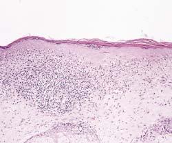 natomic Pathology / ORIGINL RTICLE Image 1, iopsy specimen of malignant melanoma in situ demonstrating a lichenoid tissue reaction with the lymphocytic infiltrate obscuring the dermal-epidermal