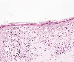 In cases 2 and 3, the clinical differential diagnosis included actinic keratosis and owen disease. In cases 1 and 2, the diagnosis was established with the help of MRT-1 immunohistochemical staining.