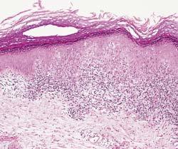 natomic Pathology / ORIGINL RTICLE C Image 3, enign lichenoid keratosis control (H&E, 100).