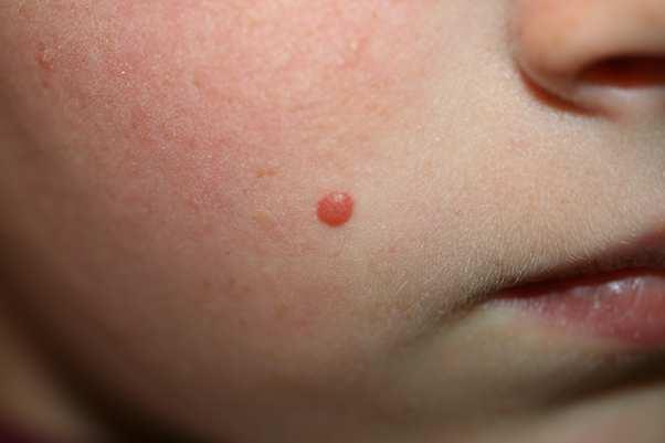 Figure 1. Spitz nevus on the right cheek of a young girl. The tumor is small, symmetrical, and dome-shaped, and lacks pigmentation.