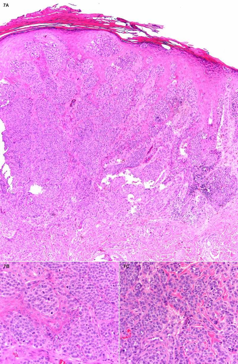Figure 7. Spitzoid melanoma from the right forearm of a 19 year old patient. The tumor was 1.6mm in thickness and exhibited a mitotic rate of 14 per mm 2.