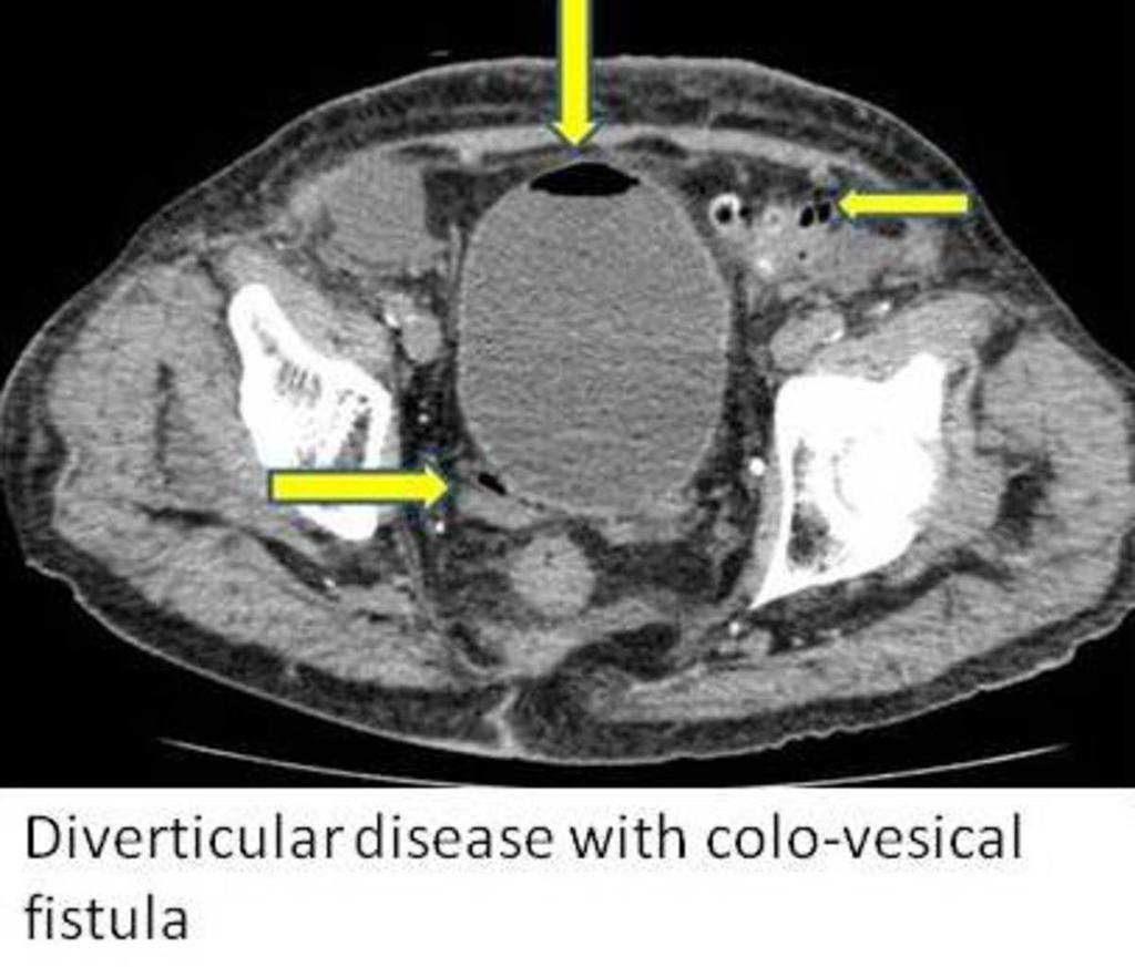 Fig. 7: Complicated diverticular