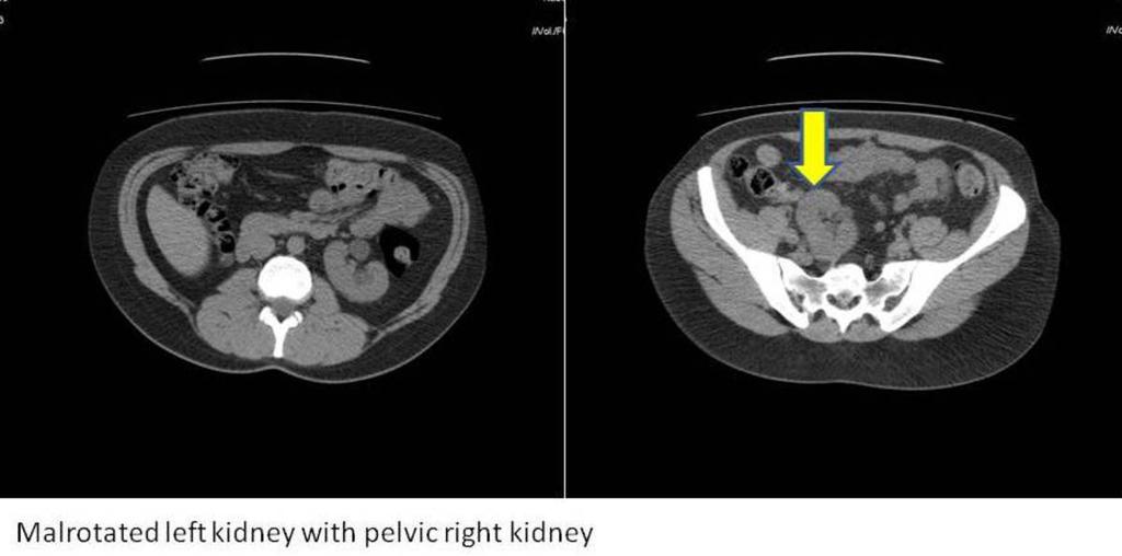 Fig. 9: Ectopic right kidney in the