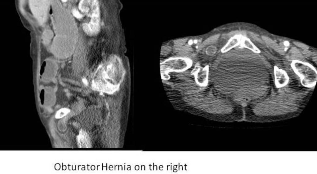Fig. 11: Obturator hernia