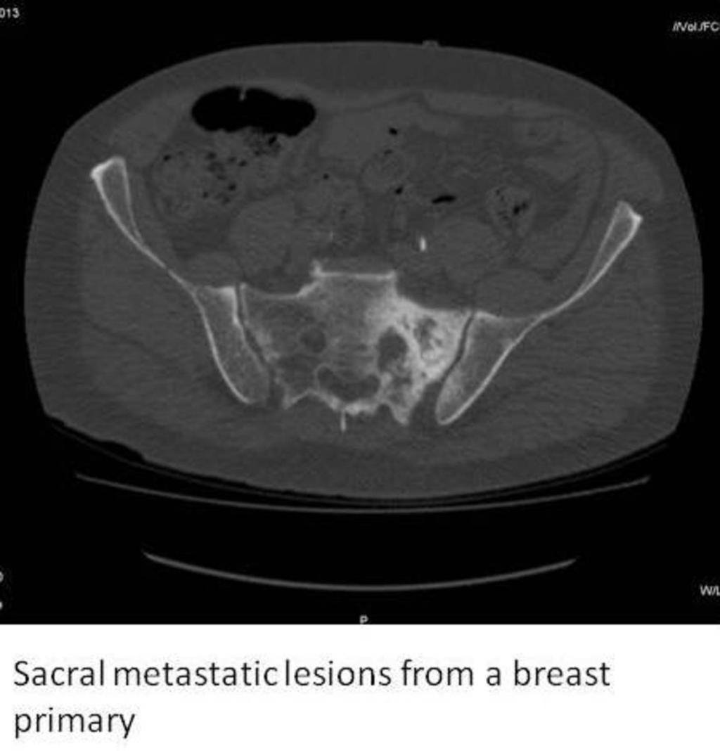 Fig. 12: Sacral metastatic lesion