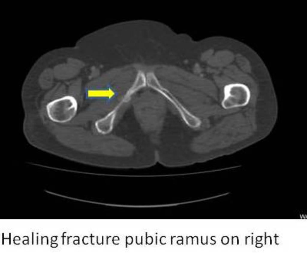 Fig. 14: Healing fracture
