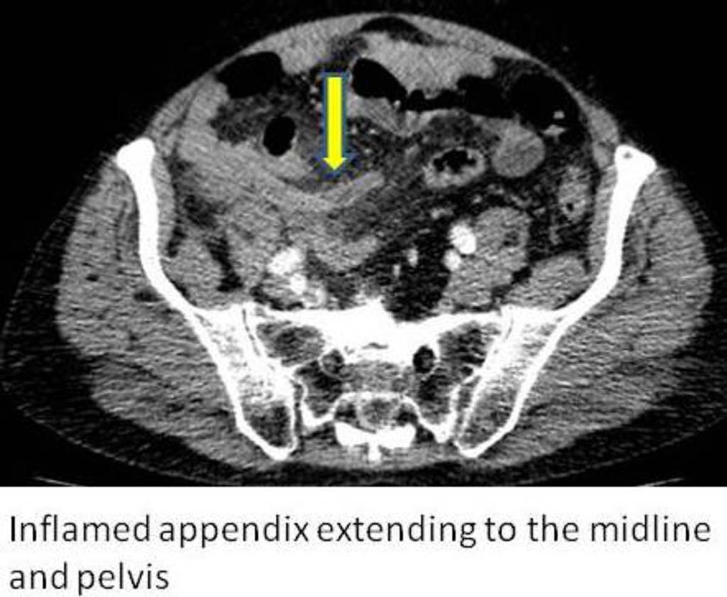 Fig. 2: Inflamed appendix extending