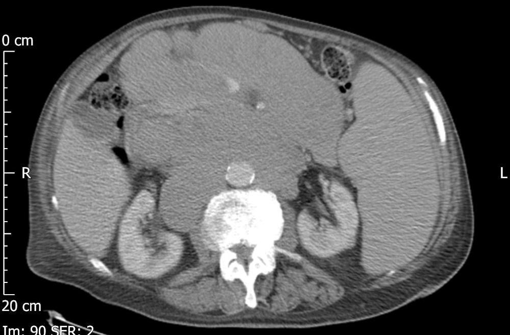 91 YEAR OLD MALE WITH MANTLE CELL LYMPHOMA Presents with B-symptoms, leukocytosis and bulky lymphadenopathy Jan 2015