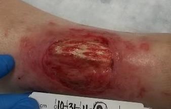 After 2 months of Enluxtra, the wound was approximately 85% granulated and erythema in periwound was nearly resolved (Fig. C).