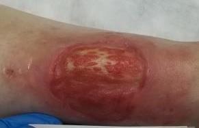 Peri-wound erythema remained controlled and the wound size was decreased to 3.5 x 5.0 x 0.25 cm (Fig. D).