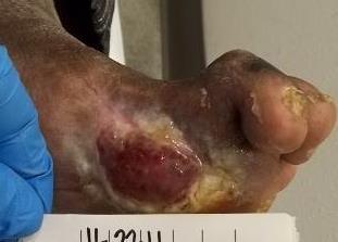 Case study 6: First metatarsal head following amputation Enluxtra Wound Dressing Clinical Results A Patient: A 75-year-old male presented with a diabetic wound of the left foot first metatarsal head