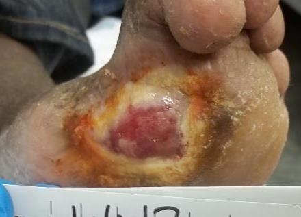At 8 weeks, skin islands were visible within the wound bed, indicating that the tissueengineered skin graft was successful (Fig. D).