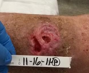 Case study 1: Chronic lower extremity venous stasis ulcer Enluxtra Wound Dressing Clinical Results Patient: A 53-year-old male presented with a draining lateral venous stasis ulcer on his left lower