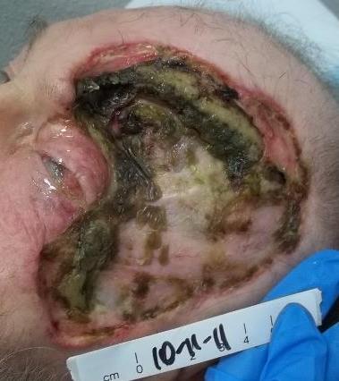 Wound Description: Continual drainage from the exposed frontal sinus was contaminating and causing inflammation to the surrounding soft tissue, prolonging wound healing process.