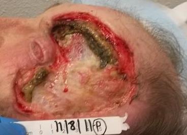 Exudate containment and maintenance of correct moisture balance throughout the entire wound led to a drastic reduction in sharp debridements and associated trauma to the exposed bone and healing