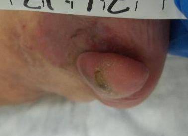 Clinical Outcomes/Conclusion: The diabetic foot ulcer showed steady progression toward closure at each dressing change with use of Enluxtra, and was completely closed at 4 months.