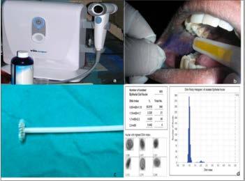Brush Biopsy OralCDx - oral brush biopsy with computer assisted analysis identifies dysplasia in areas without suspicion Exfoliative cytology from full thickness mucosa - painless Most results benign