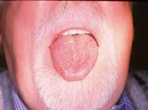 Xerostomia (salivary hypofunction,