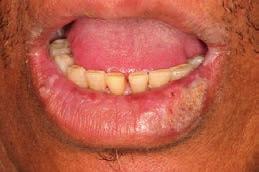Actinic Cheilitis (Sailor s Lip; Solar Cheilitis Type of actinic keratosis - 6-10% transformation rate) Lower Lip White men > 40 yoa Vermilion - atrophic, pale, glossy surface, loss of demarcation at