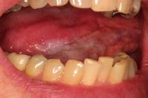 Leukoplakia White Patch - asymptomatic White plaque that cannot be rubbed off Should be biopsied - up to 20% may exhibit