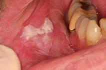 Leukoplakia Proliferative Verrucous Leukoplakia Very high rate of malignant change Thick, exophytic (flat in early stages)