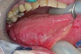 Erythroplakia Oral Lichen