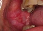 Erythematous, Erosive Oral