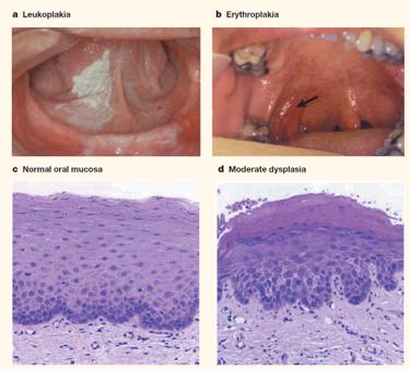 Premalignant lesions Premalignant lesions - Leukoplakia - Erythroplakia - Lichenoid lesions - Submucous fibrosis Erythroplakias have