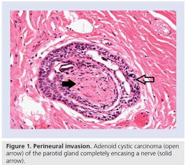 Perineural Invasion in SGC Cancer cell invasion in, around and through nerves or the finding of tumor cells within any of the the layers (epineurium, perineurium, endoneurium) of the