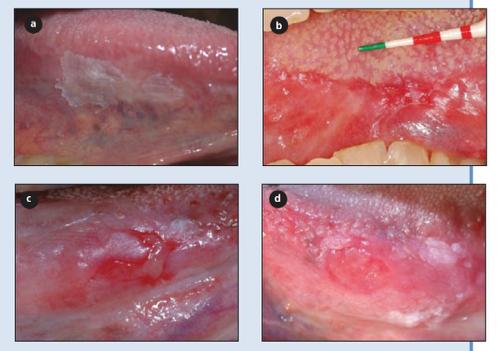 Clinical evaluation Appearances of oral premalignant and early cancer smooth, white, homogeneous red,