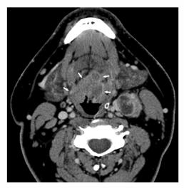 HPV- associated Head and Neck Cancers HPV- positive HNSCC Typically well defined borders Axial contrast- enhanced