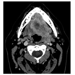 HPV- associated Head and Neck Cancers HPV- negative HNSCC Deep muscular invasion involving the extrinsic muscles of the tongue with submucosal spread