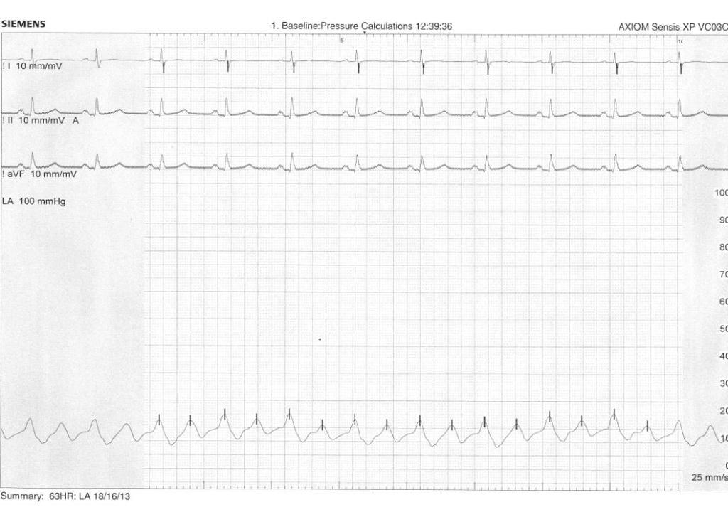 Haemodynamics of ASD closure Repeat balloon occlusion of ASD with a sizing balloon and measurement of LA