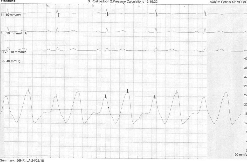 Haemodynamics of ASD closure Repeat balloon occlusion of ASD with a sizing balloon and measurement of LA pressures: Baseline LVEDP = 18 mmhg, LA = mean 14 mmhg