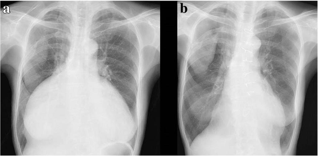 Okada et al. Journal of Cardiothoracic Surgery (2018) 13:83 Page 2 of 5 Fig. 1 a Chest X-ray at preoperative examination showed severe enlargement of the heart, with a cardiothoracic ratio of 88%.