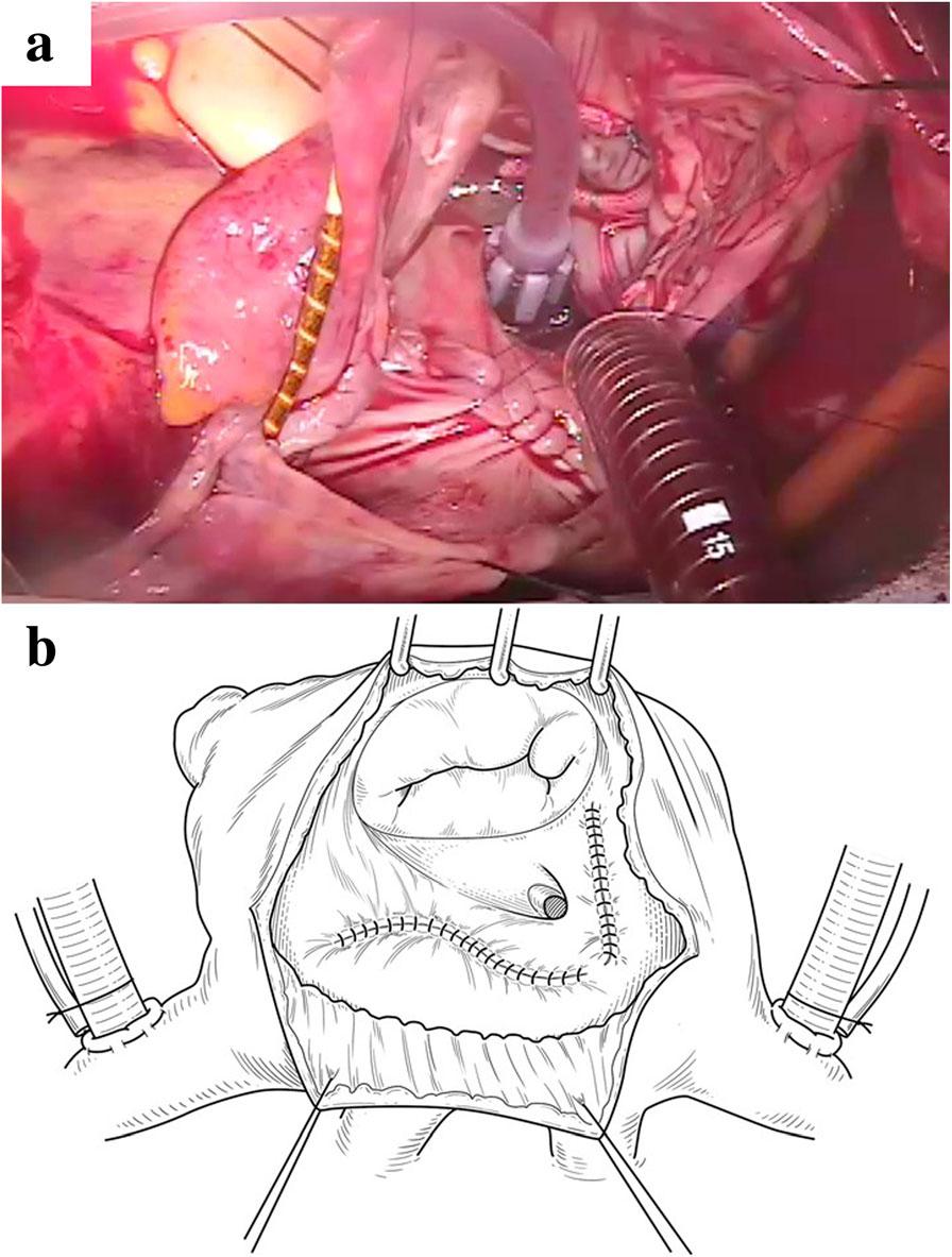 Okada et al. Journal of Cardiothoracic Surgery (2018) 13:83 Page 4 of 5 Fig. 4 a Intraoperative findings.
