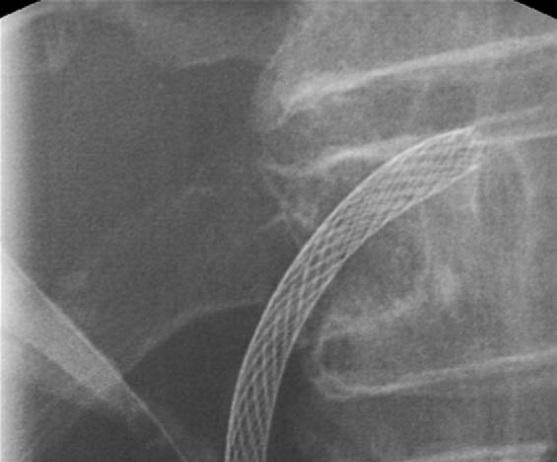 metal stents in malignant biliary