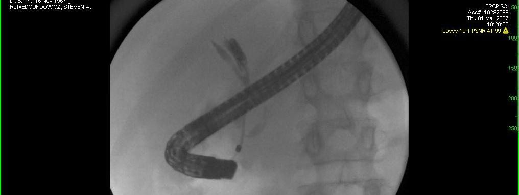 Bifurcation stenting options Plastic stents With or without additional side holes
