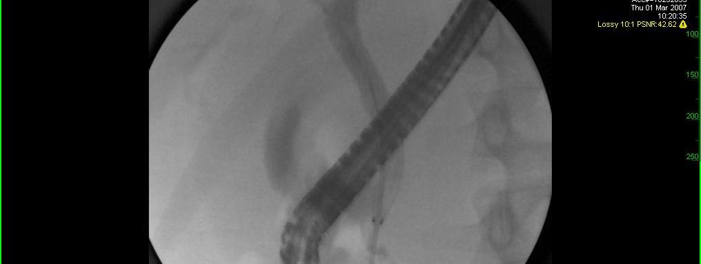 Bifurcation tumor Stent in Stent technique Place stent with wide mesh into