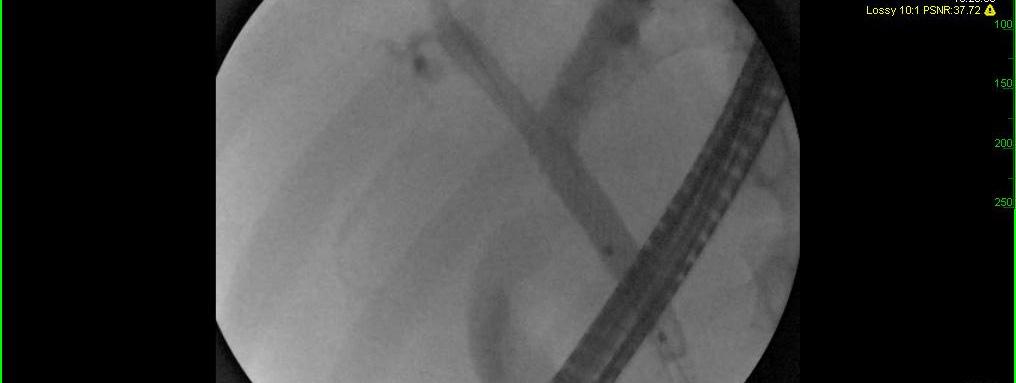tumor Stent in Stent technique Recannulate the stent and using the wire as