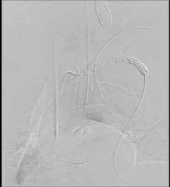 17 th 2017) Confida wire in ascending aorta via LFA; TOE in place.