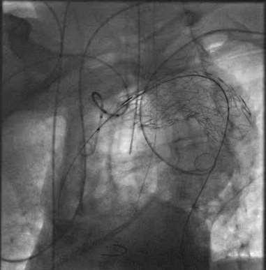 Case 2 (expanding arch aneurysm) Fully percutaneous exclusion of arch aneurysm and coiling of